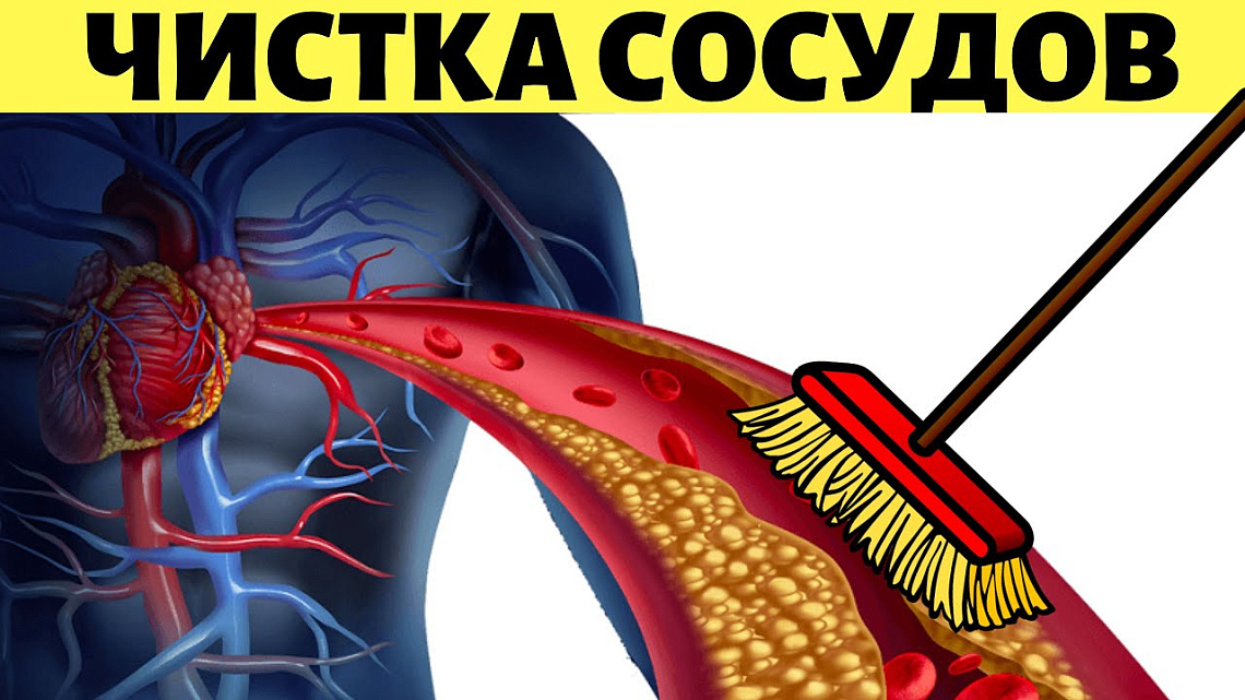 Можно ли чистить сосуды чесноком, грецким орехом и капельницами? Можно ли чистить сосуды чесноком, грецким орехом и капельницами?
